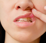 What causes canker sores? : http://health.sunnybrook.ca/wellness/what-is-a-canker-sore/