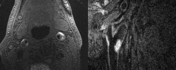 Magnetic resonance images of the carotid arteries showing intraplaque hemorrhage (bright regions)