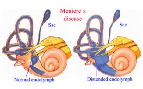 Meniere’s Disease - What is Meniere’s Disease? - Sunnybrook Hospital