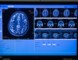 Close-up on monitor showing brain scan