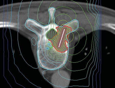 Photodynamic therapy shown in an x-ray.