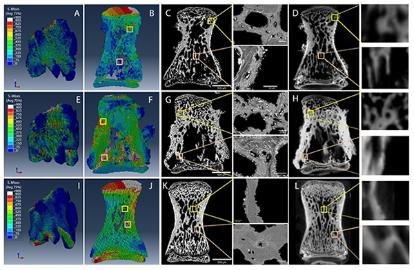  Micro Finite Element Modelling, Backscatter Electron Imaging and µCT imaging of BaSO4 stained Osteolytic (top), Mixed (middle) and Control (Bottom) vertebrae. 