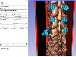 Virtual simulation tool for spinal surgery.