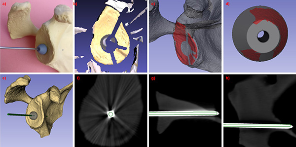 Optical tracker on a sawbone scapula, structured light image of the scapula and optical tracker, registration of optical glenoid surface image to CT data, registration of optical fiducial image to its computer model, 3D model of registered fiducial and predicted guidepin position, predicted (green) and actual guidepin position for sagittal, axial, and coronal planes.