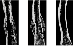 An X-ray of a bone fracture.