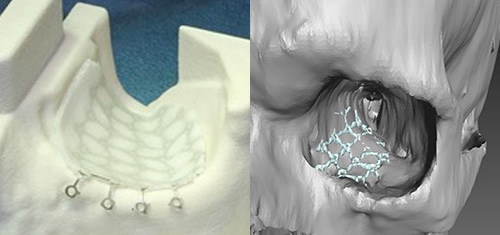 CMFS implants are shown side-by-side.