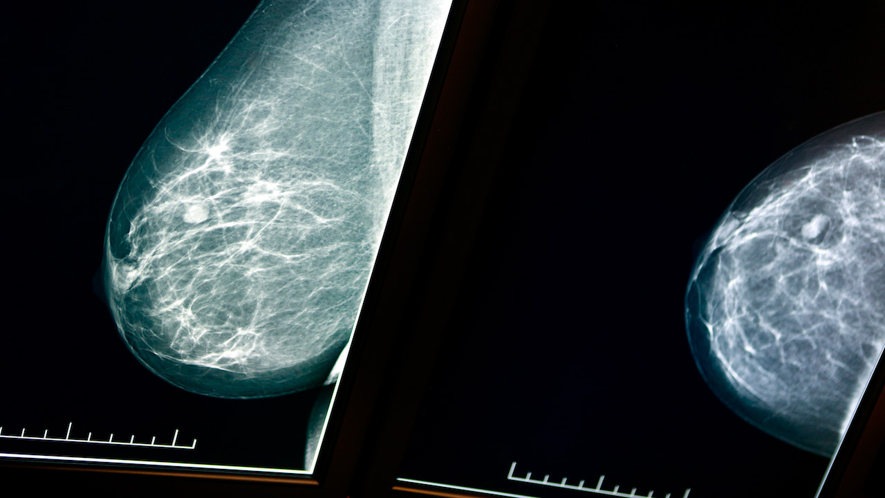 Breast Density A Risk Factor For Cancer Sunnybrook Hospital