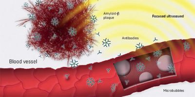 Microbubbles injected into bloodstream