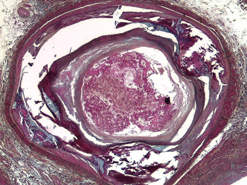 Microscopic view of a blocked leg artery