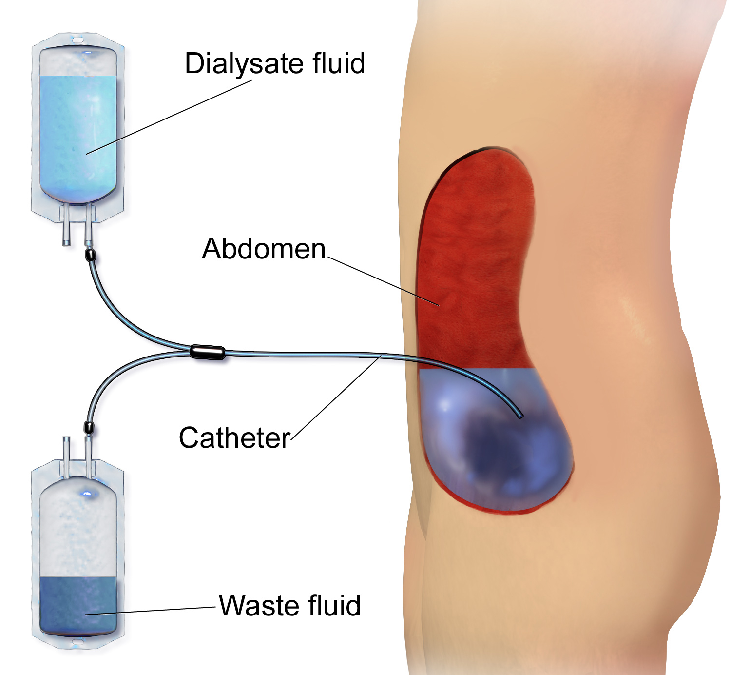 Continuous Ambulatory PD diagram showing: Dialysate fluid, abdomen, catheter, waste fluid