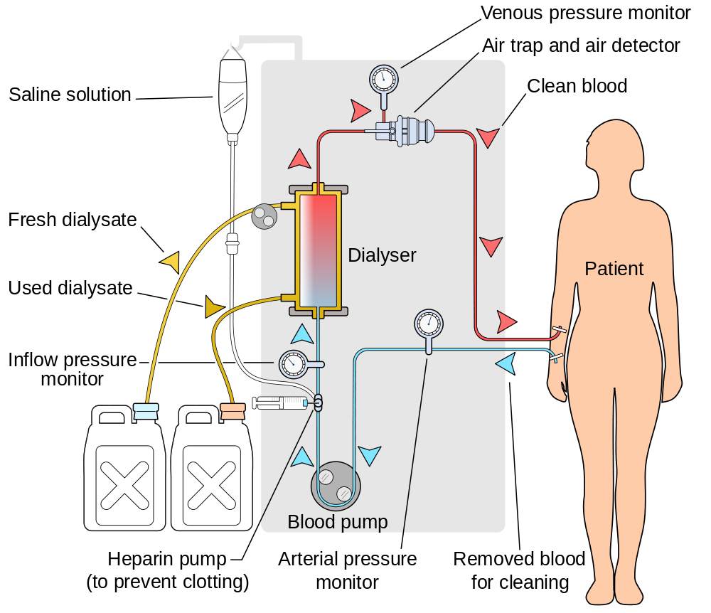 Hemodialysis diagram