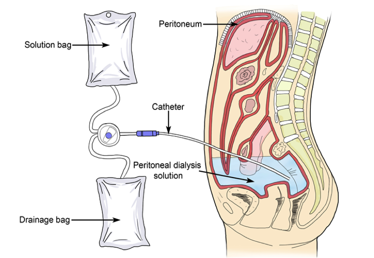 Peritoneal Dialysis diagram from NKFS.org