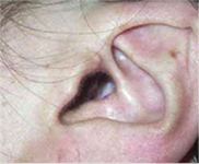 Ear canal opening enlarged after mastoidectomy