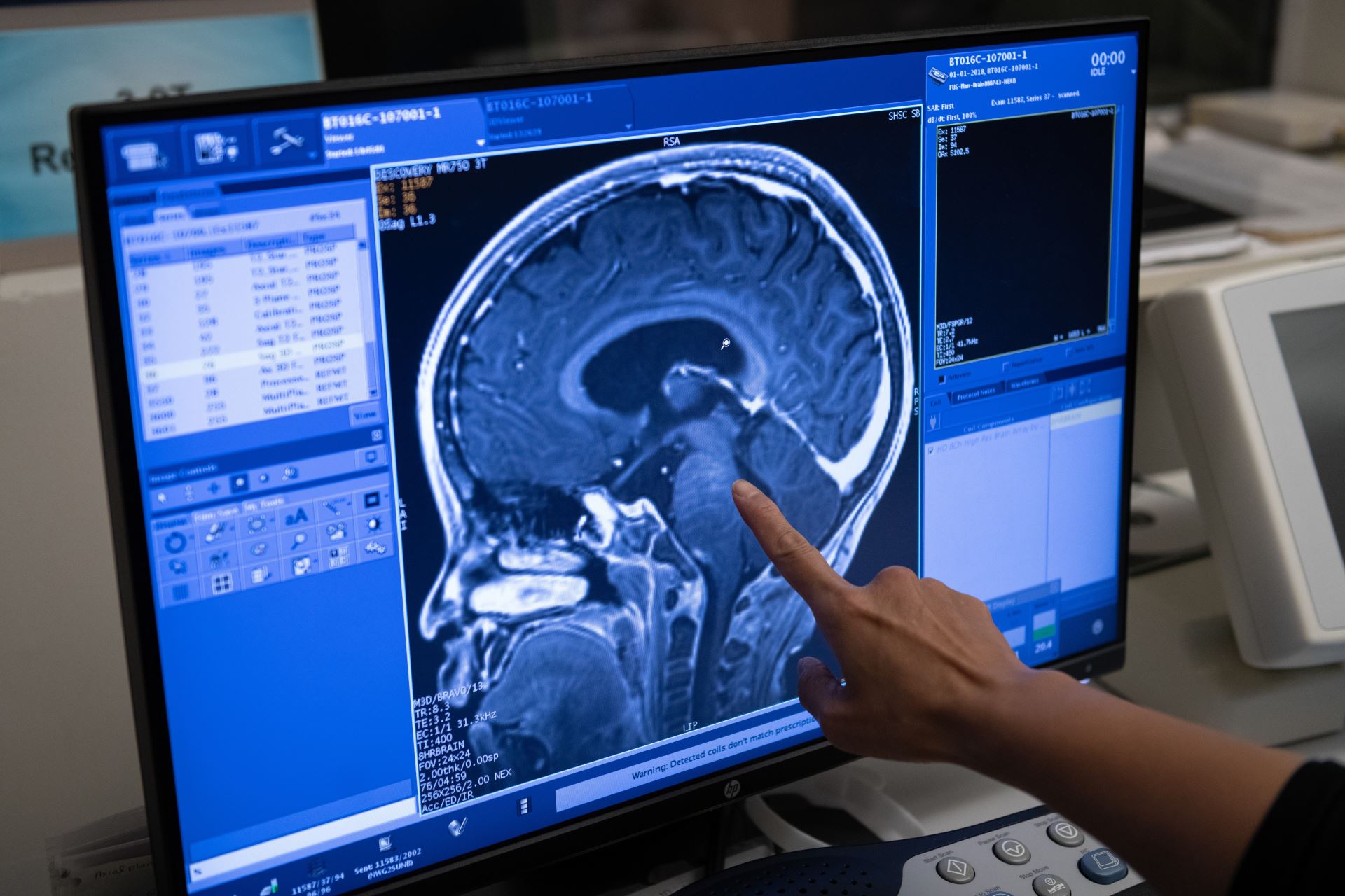 World first: Sunnybrook and SickKids clinical trial delivers chemotherapy to pediatric brain tumours using MRI-guided focused ultrasound