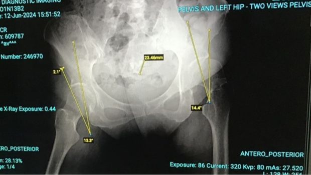 An x-ray image of the pelvis 