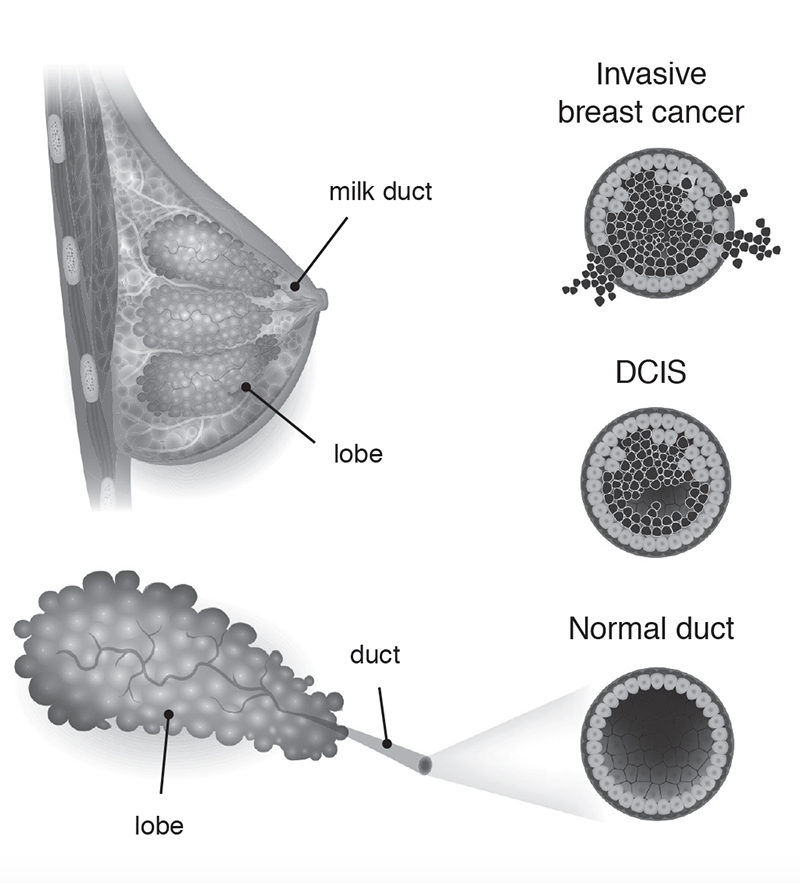 What Is Ductal Carcinoma In Situ Dcis Sunnybrook Hospital