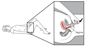 Vaginal dilator insertion diagram.