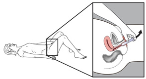 Vaginal dilator removal