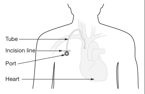 A diagram of the incision line for immunotherapy.