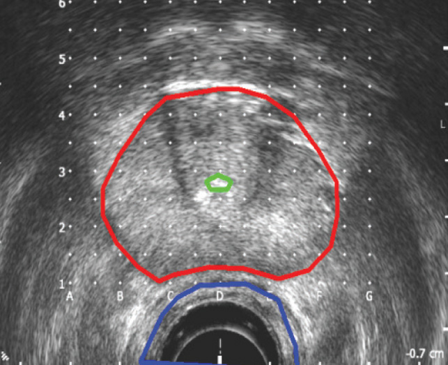 The ultrasound shows the size and shape of the prostate as seen on TRUS.