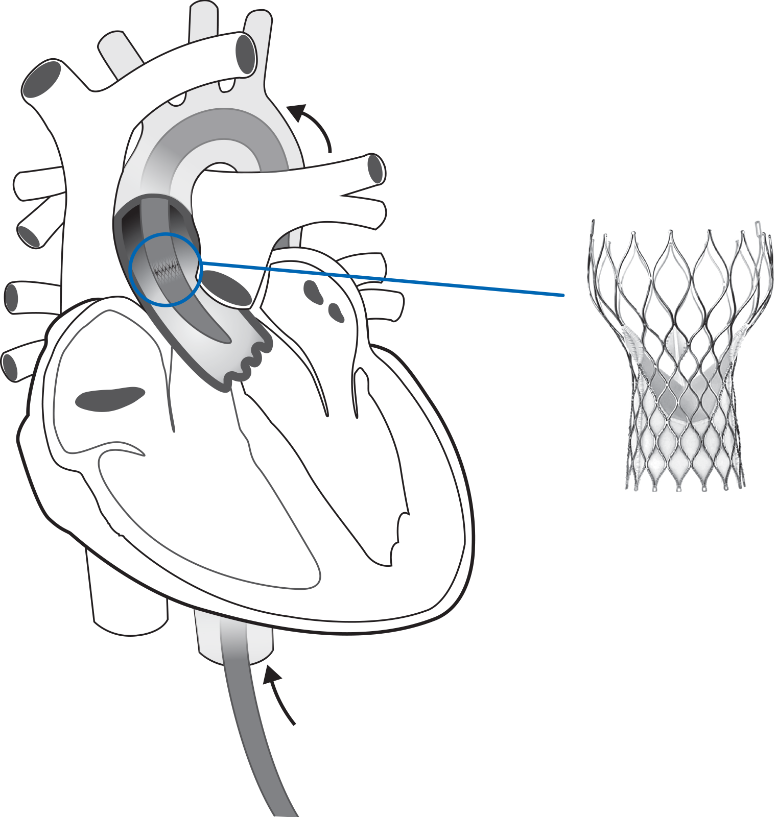 Transcatheter Aortic Valve Implantation.