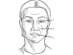 Drug Combo May Improve Symptoms for Bell Palsy Patients - Sunnybrook ...