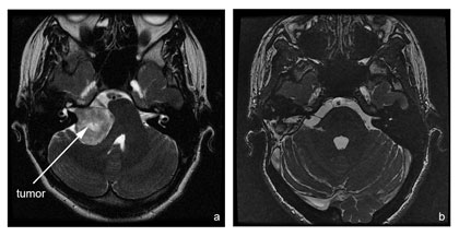 Acoustic Neuroma - Sunnybrook Hospital