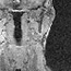 An MRI of the back of the neck